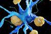 Amyloid plaque