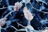 Amyloid plaque formation